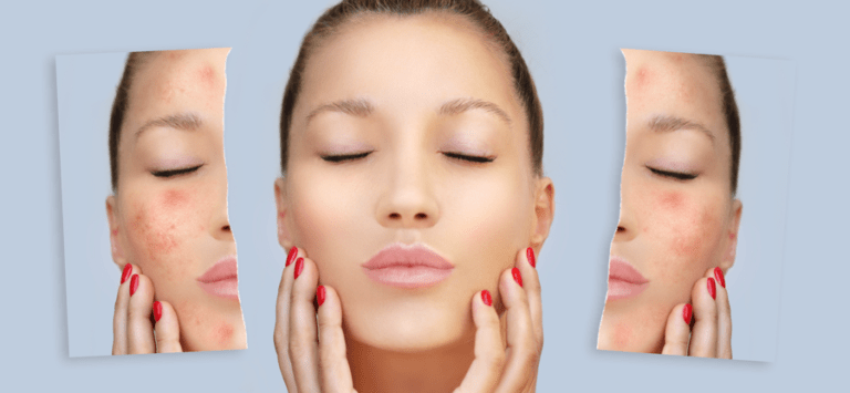 IPL Acne Therapy - Skinfinity Medspa | Gilbert, AZ