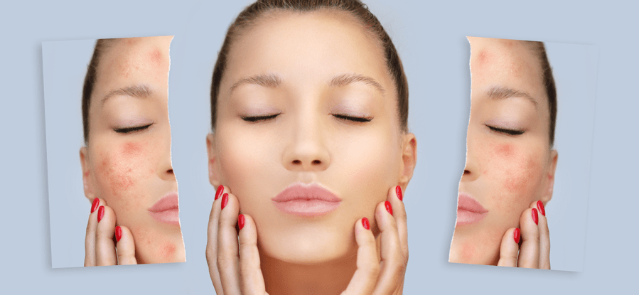 IPL Acne Therapy